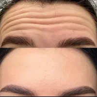 تزریق ژل و بوتاکس|خدمات آرایشگری و زیبایی|دوگنبدان, |دیوار