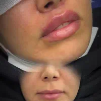 لیفت لب ها/سانترال لب/کاملا طبیعی و نچرال/اقساط