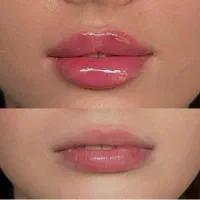 خدمات ژل و فیلر با 25 سال سابقه پزشکی