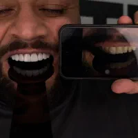 روکش ایمپلنت دیجیتال و کامپوزیت و روکش زیرکنیوم