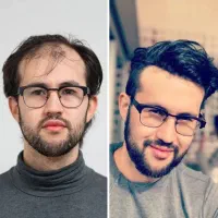 کاشت مو و ابرو شیرازی