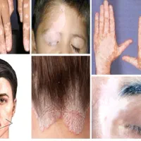 پیسی وویتیلیگو