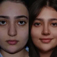 کوچک کردن بینی بدون جراحی
