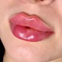 تخفیف ژل و بوتاکس ،فول فیس ،لیزر و جوانسازی یلدا