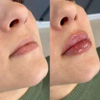 ژل وبوتاکس