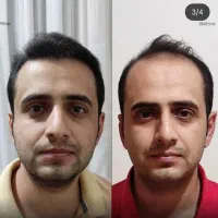 اقتصادی ترین کلینیک کاشت مو و ابرو در تهران/ اقساط|خدمات آرایشگری و زیبایی|تهران, سعادت‌آباد|دیوار
