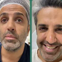 ژل و بوتاکس فول فیس مادلینگ ژل لب چالگونه اموزش ژل