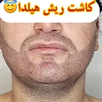 مدل کاشت مو و ابرو جهت تولید محتوا|خدمات آرایشگری و زیبایی|قم, پردیسان|دیوار