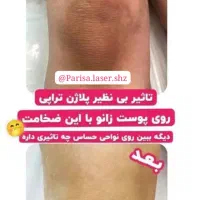 لیزر موهای زائد بدن|خدمات آرایشگری و زیبایی|شیراز, تحویلی|دیوار