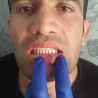 ساخت دندان مصنوعی یک روزه و ضمانتی.المانی و ژاپنی