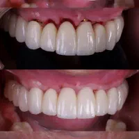 دندانپزشکی پایه ایمپلنت کره ۱۵تومن بدون پیش پرداخت