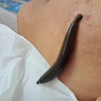 ریلکسیشن حجامت زالو