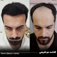 کلینیک فوق تخصصی/کاشت مو / ابرو|خدمات آرایشگری و زیبایی|زاهدان, |دیوار