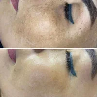 فشیال پوست رفع لک در مطب زیبایی .بانوان -اقایان|خدمات آرایشگری و زیبایی|شیراز, رازی|دیوار