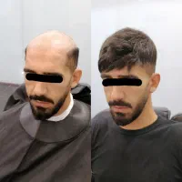 پروتز مو کاشت مو بدون درد و نقاهت وخونریزی 2 ساعته