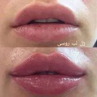 کیلینیک نوین تزریق ژل چربی بوتاکس مزو پی آرپی|خدمات آرایشگری و زیبایی|رشت, گلسار|دیوار