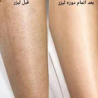لیزر موهای زائد لیزرفول لیزر آقایان  لیزر بانوان|خدمات آرایشگری و زیبایی|اصفهان, باغ زرشک|دیوار