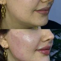 خدمات تخصصی تزریق ژل افر هر سی سی ۸۰۰