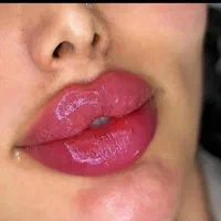 جشنواره تزریق تخصصی ژل و بوتاکس کلینیک نورا