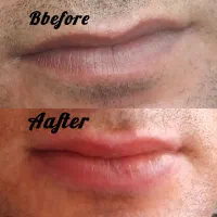 مدرن ترین روش رفع تیرگی لب(با تخفیف ویژه)