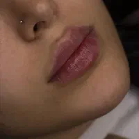 بوتاکس ژل لب خط خنده چانه گونه|خدمات آرایشگری و زیبایی|گرگان, |دیوار