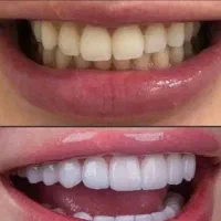 ثبت نام بیمه دندانپزشکی و کامپوزیت طلایی شو|خدمات آرایشگری و زیبایی|گرگان, |دیوار