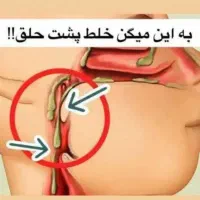 درمان خلط پشت حلق