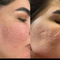 بوتاکس مزو ژل