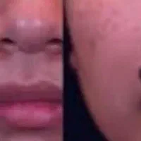 لیزرخال وزگیل منگوله های گوشتی بدون درد|پزشکی|دورود, |دیوار