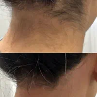 لیزر سوپرانوتیتانیوم ۲۰۲۵مطب پوست مو مایا تهرانسر|خدمات زیبایی و سلامت|تهران, تهرانسر شمالی|دیوار