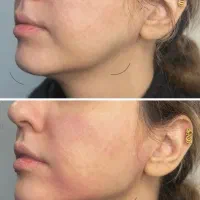 تزریق ژل و بوتاکس تضمینی|خدمات آرایشگری و زیبایی|اهواز, نادری|دیوار