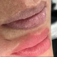 رفع کبودی - شیدینگ لب - فیبروز ابرو