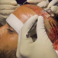 مدل کاشت مو و ابرو جهت تولید محتوا|خدمات آرایشگری و زیبایی|قم, پردیسان|دیوار