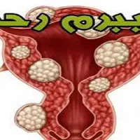 پاکسازی و بهبود رحم ،کیست،فیبروم و تنبلی تخمدان