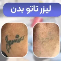 پاک کردن تاتو با پیشرفته ترین لیزر حال حاضر دنیا|خدمات آرایشگری و زیبایی|کرمانشاه, |دیوار