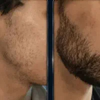 ریش و سبیلت پرپشت میشه (بدون بازگشت)