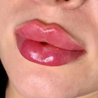 ژل/فیلر/بوتاکس/پی آرپی/بایو فیلر و چربی|خدمات آرایشگری و زیبایی|کرج, گوهردشت|دیوار