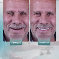 ایمپلنت با کمترین درد،کامپوزیت و لمینیت|خدمات آرایشگری و زیبایی|مشهد, جانباز|دیوار