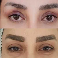 بلفاروپلاستی ساکشن غبغب|خدمات آرایشگری و زیبایی|اصفهان, مهدی آباد|دیوار