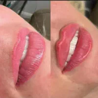 ژل و بوتاکس