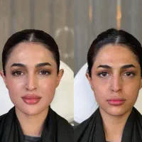 فیلرلب ژل پک کانتورینگ۴م بوتاکس prpرایگان فیلربادی