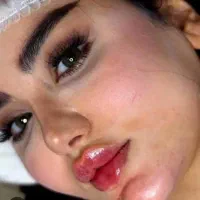 اف ژل و بوتاکس