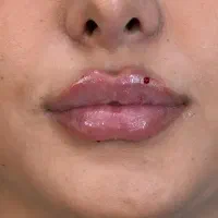 مزوتراپی