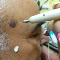 برداشتن زگیل تناسلی برای آقایان و خانم هادریکجلسه