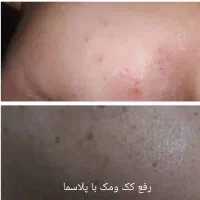 مزونیدلینگ کل صورت و پاکسازی وخالبرداری وآموزش|خدمات آرایشگری و زیبایی|یزد, |دیوار