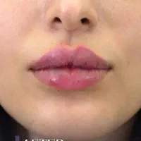 تزریق ژل و بوتاکس جشنواره عید|خدمات آرایشگری و زیبایی|تهران, عبدل‌آباد|دیوار