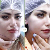 ساکشن غبغب با آفرویژه