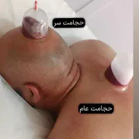 آموزش دوره تخصصی حجامت فصد زالو بادکش|خدمات آموزشی|کرج, کمال‌شهر|دیوار