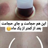 رگگیری.اصلاحی.زالودرمانی.حجامت.اصلاحی|خدمات آرایشگری و زیبایی|کاشان, دشت چال|دیوار