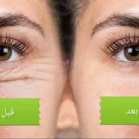 زیبائی پلک بالا و رفع پف زیر چشم|خدمات آرایشگری و زیبایی|شهرضا, |دیوار